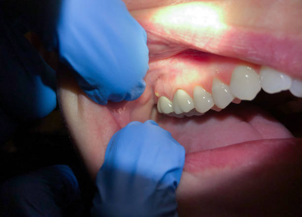 Best Emergency Treatment for Oral Infections in Abita Springs, LA